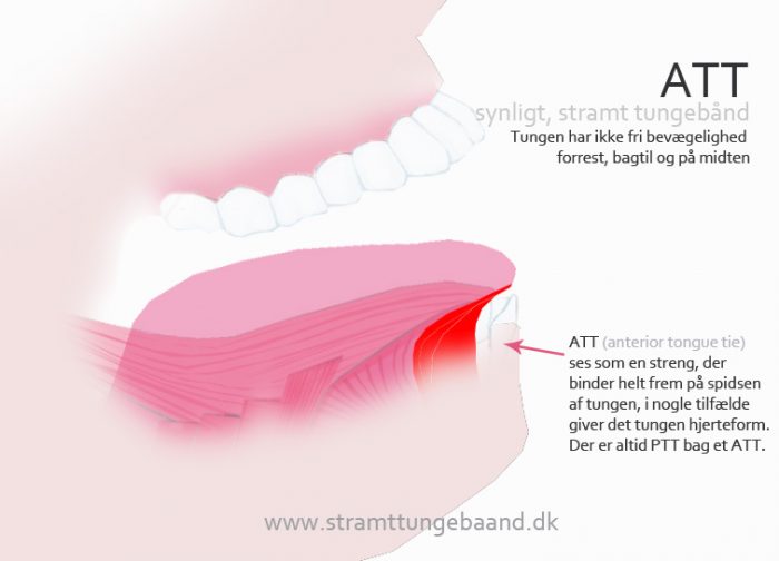 ATT anterior tongue tie stramt tungebånd
