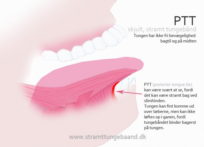 PTT skjult stramt tungebånd posterior tongue tie