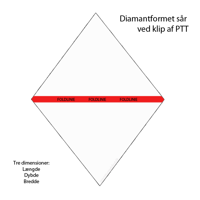 Såret skal vokse sammen vertikalt, når man får klippet et stramt tungebånd