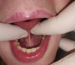 Anettes tungebånd før klip af den hollandske tandlæge, Dr. Kirsten Slagter. Hun vidste i årevis ikke, at hun havde smerter fra et stramt tungebånd.